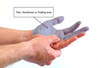 Signs of carpal tunnel syndrome in man, showing are of pain, numbness or tingling. 