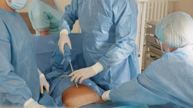 In the operating room, the doctor does a laparoscopy. Real Surgery, abdominal incision, working with surgical laparoscopy instruments. Gynecology