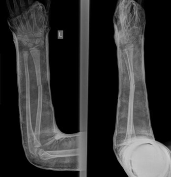 Broken hand wearing cast x-ray image