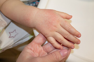 Red spots on the skin of the hands of a child. children's allergy. Dryness and irritation of the...