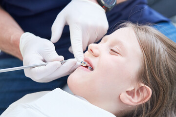 Braces for child teeth correction. Installation and maintenace - 496088766