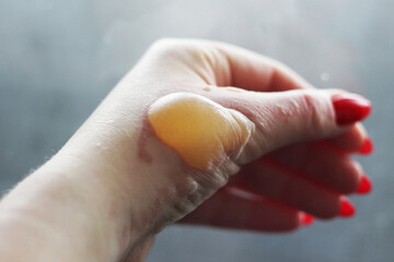 hand and fingers with real burn hot oil with bubble close-up