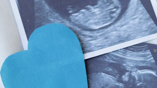 two ultrasound pictures on the bed with blue paper heart, means it's a boy. 
2 different pictures from ultrasound from different gestational period. motherhood concept. happy with pregnancy