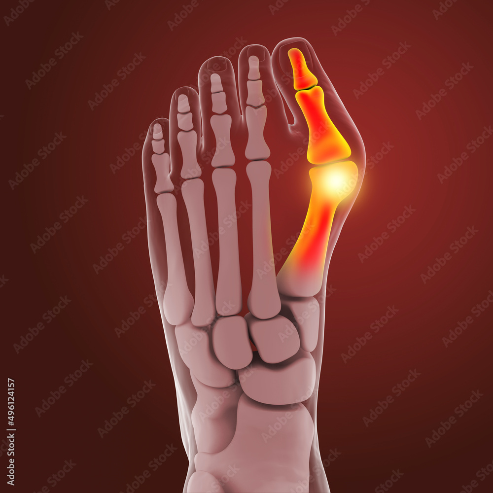 Wall mural Toe deformation, also known as hallux valgus, or bunion