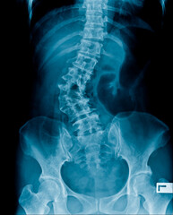 X-ray image of abdomen show spine and pelvic bone, lumbar spondylosis and degenerative change and deformity in scoliosis shape