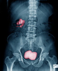 Renal calculus kidney stone and big blader stone with Cancer development inside of blader in this case