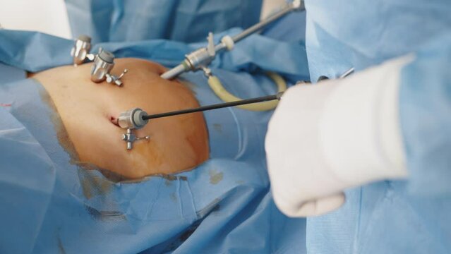 Instruments for laparoscopic surgery at work. Process of surgery operation using laparoscopic equipment. Operating room with surgery equipment