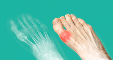 X-ray and the same foot with red pain. Rheumatoid arthritis. Osteoarthritis