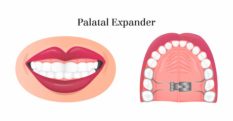 Vector isolated illustration with palatal expander, bottom view. Concept treatment of orthodontic problems, straightening, fixing of teeth, orthodontic structures. It can be used in banner design, web - obrazy, fototapety, plakaty
