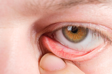 Red lower eyelid, a macro photo of the human eye. Conjunctivitis, inflammation of the mucous...