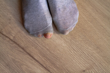 Obraz na płótnie Canvas Torn gray socks on a man's feet, fingers sticking out of holes in the fabric