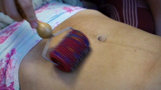 A postpartum doula makes a massage on the belly of a woman after childbirth with a roller with needles. Scar healing after caesarean section.
