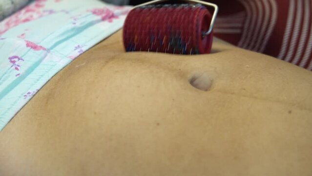 A postpartum doula makes a massage on the belly of a woman after childbirth with a roller with needles. Scar healing after caesarean section.