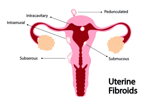 Uterine Fibroids illustration. Fibroids in the uterus also called leiomyomas or myomas
