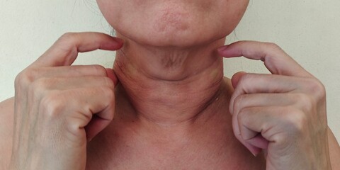 Naklejka premium Portrait showing the fingers holding the flabbiness adipose under the neck, problem wrinkled and cellulite skin under the chin, concept health care.