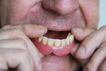 Close-up portrait of a caucasian pensioner wearing dentures. Dental prosthetics. Loss of zkbs in...