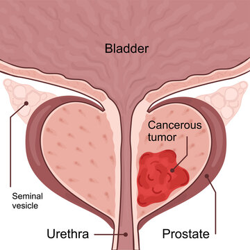 Medical diagram of 2 stages of prostate cancer.