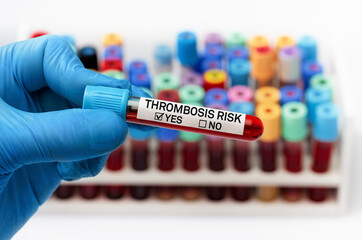 Blood sample test with positive diagnosis of Thrombosis risk in a coagulation test. doctor holding Blood tube positive analysis to high risk thrombus - obrazy, fototapety, plakaty