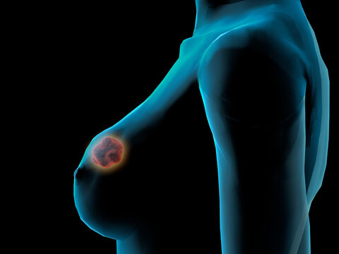 Side profile of a woman suffering from breast cancer