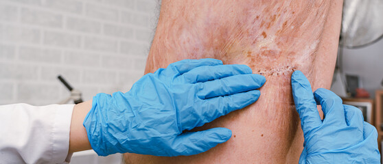 Doctor  treating  wound, burn. Emergency room hospital.The doctor examines the patient, severe burn - 496375909