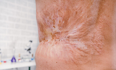 Man with a severe burn all over his body. Close up. - 496375912