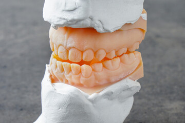 Teeth mold of an underbite malocclusion used for jaw surgery.