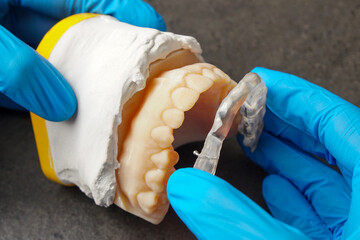 Dentist adjusting a dental splint - obrazy, fototapety, plakaty