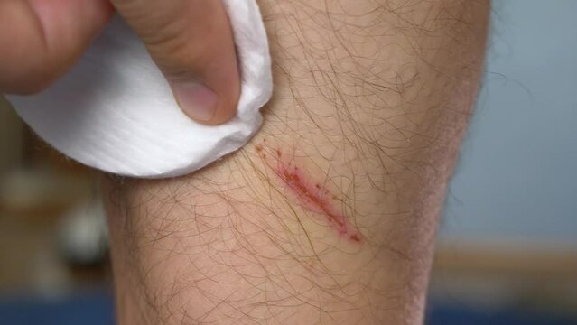 Male hand rubs oxygenated water on scratch hematoma on leg. Decontamination and disinfection of wound by cotton ball