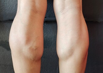 Portrait of the calf muscles and blood vessels on the legs of the woman, concept health care.