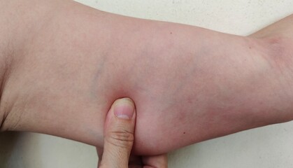 Portrait showing the fingers holding the flabbiness adipose hanging under the arm, problem skin of the woman, concept health care.