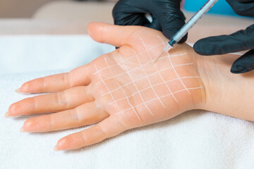 Professional cosmetology. Doctor makes injections of botulinum toxin on the female palm against hyperhidrosis. Hand with white drawn grid. Close up