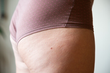 cellulite or orange crust on  feet. Reducing overweight and struggle with cellulite, subcutaneous fat deposition