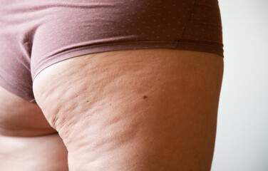 cellulite or orange crust on  feet. Reducing overweight and struggle with cellulite, subcutaneous...