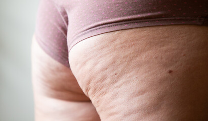 cellulite or orange crust on  feet. Reducing overweight and struggle with cellulite, subcutaneous fat deposition