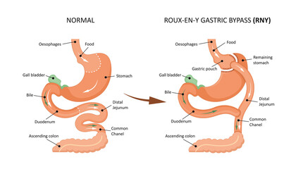 Roux-en-y gastric bypass (RNY). Showing a gastric pouch and gastrojejunal anastomosis. - obrazy, fototapety, plakaty