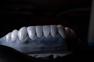 carillas monolíticas