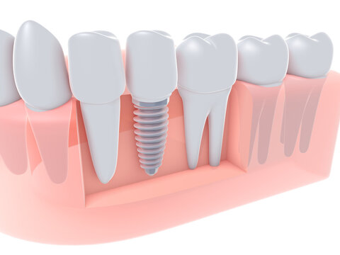 3d illustration of a dental implant inserted into a gum, along with teeth and molars. Anatomical view of denture on white background.