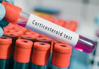 Anti M&uuml;llerian AMH ovarian function and fertility test result with blood sample in test tube on doctor hand in medical lab