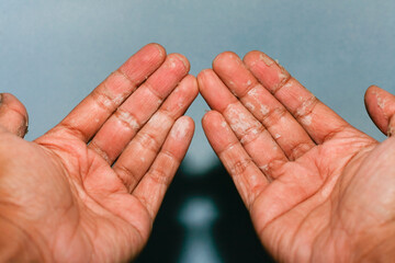 The dry skin in hands, peel, contact dermatitis, fungal infections