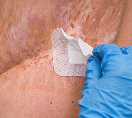 Doctor  treating  wound, burn. Emergency room hospital.The doctor examines the patient, severe burn