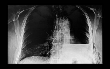 Chest  X- ray showing a left pneumonectomy and left effusion. Medical themes