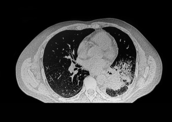 CAT -Scan of male patient with lung tumor. Medical themes.