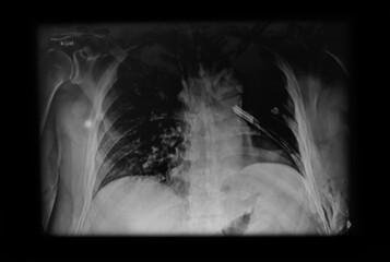 Chest X- ray showing chest tube. Medical themes