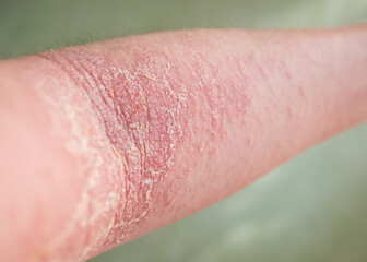Close-up view of the eczema on a person's arm.