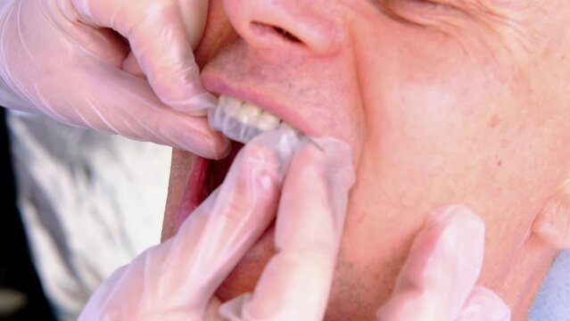closeup doctor conducts an examination of oral cavity of old male patient, tries on Silicone Night Mouth Guard for Teeth Clenching Grinding Dental Bite Sleep Aid, concept of dental services