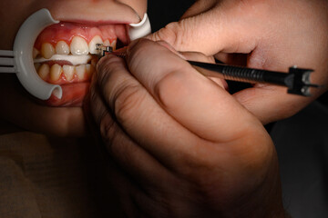 The orthodontist installs braces for the student's boyfriend, visits to the dentist, installation...