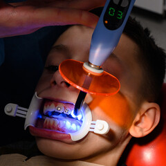Alignment of crooked teeth with the help of braces, installation of braces for a child, an...