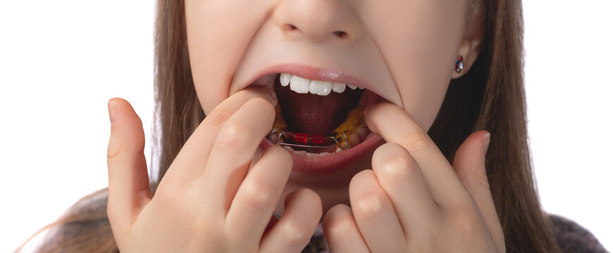 A cute little girl is putting on an orthodontic appliance. The concept of oral hygiene in childhood. Studio photo on a white background.