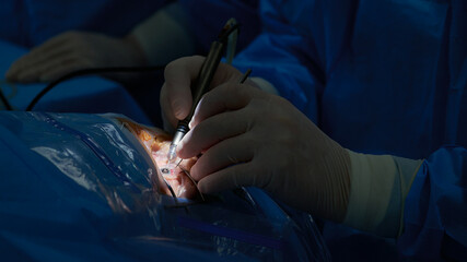 Operacja zaćmy, katarakta, zbliżenie operowanej gałki ocznej, sala operacyjna, blok operacyjny