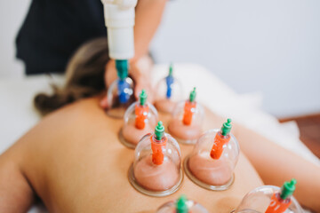 Suction cups placed on a female patient's back, by a massage therapist. Medical spa massage center.